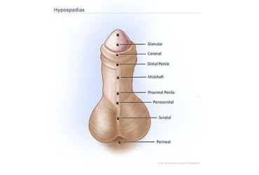 hypospadias-antalya-plastic-surgery-1