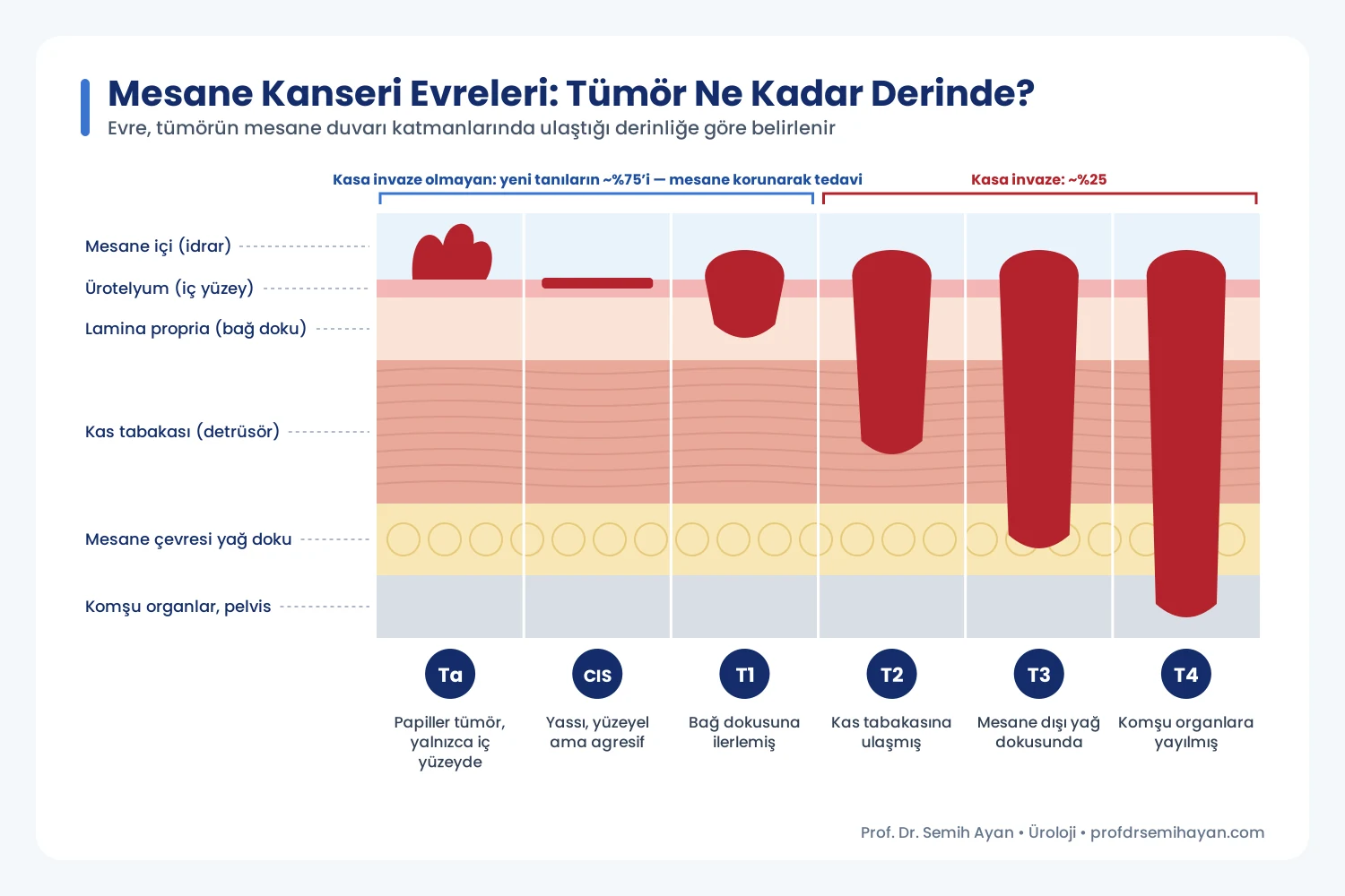 Mesane duvarının katmanları ve mesane kanseri evreleri (Ta, CIS, T1, T2, T3, T4)